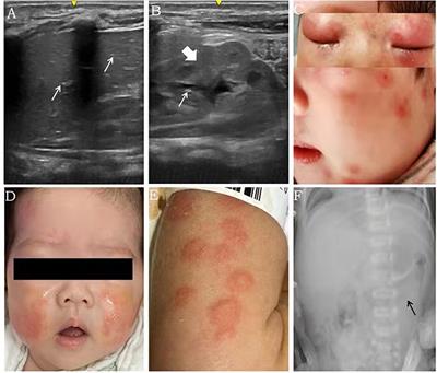 The challenging diagnosis of food protein-induced enterocolitis syndrome: A case report series